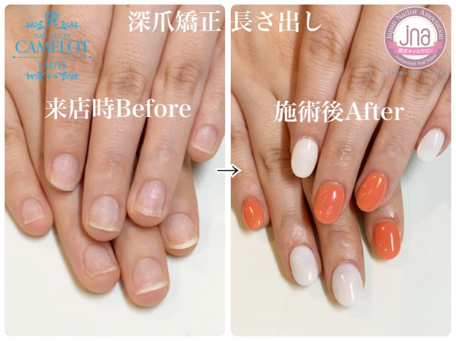 ネイルサロンキャメロット深爪矯正お客様ネイルのご紹介 深爪矯正ネイルサロンキャメロット 池袋店 恵比寿店