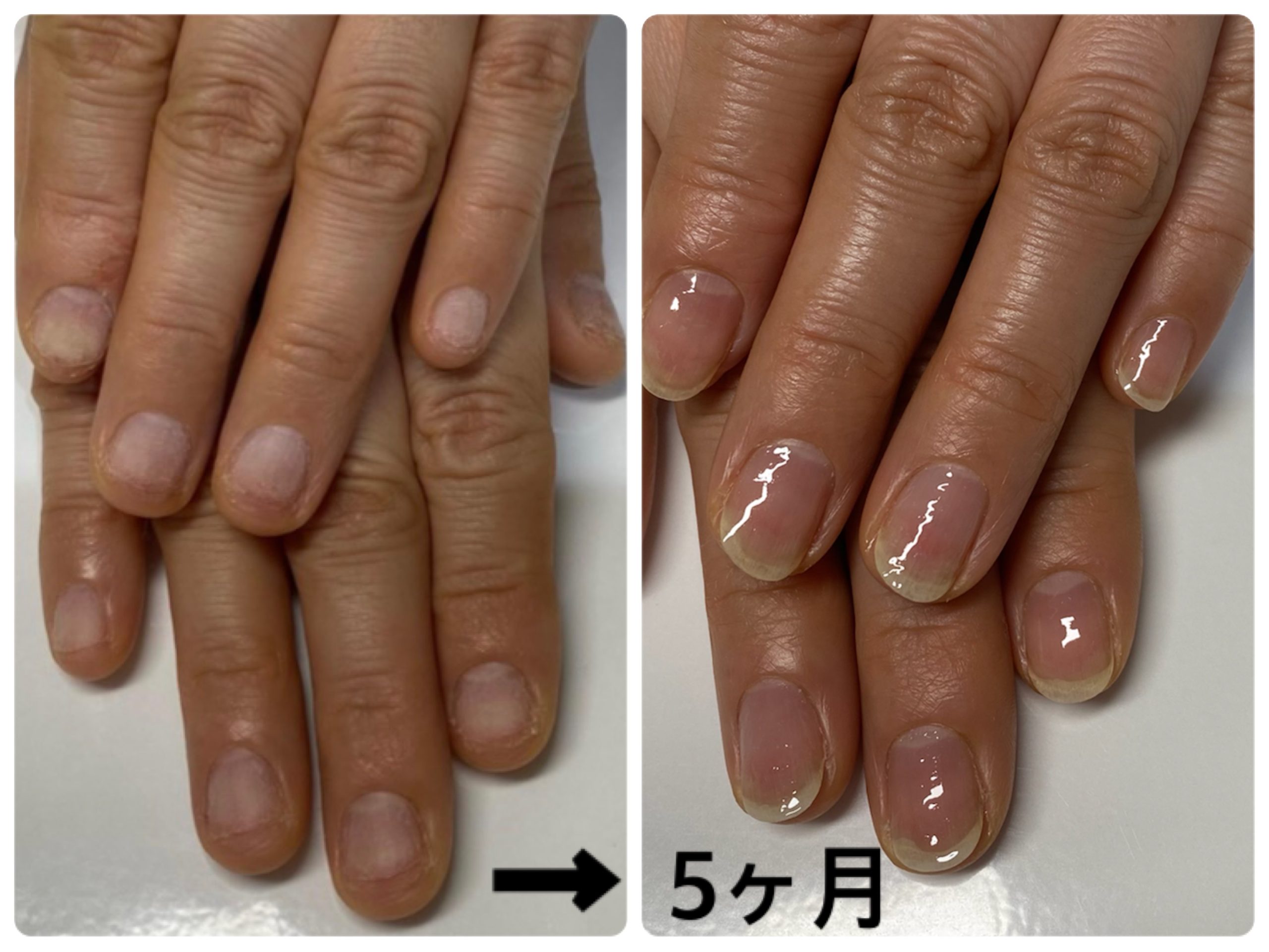 アトピー爪 でこぼこ爪の見た目改善 深爪矯正ネイルサロンキャメロット 池袋店 恵比寿店 東京駅八重洲北口店 アトピー爪 でこぼこ爪の見た目改善 深爪矯正ネイルサロンキャメロット 池袋店 恵比寿店 東京駅八重洲北口店