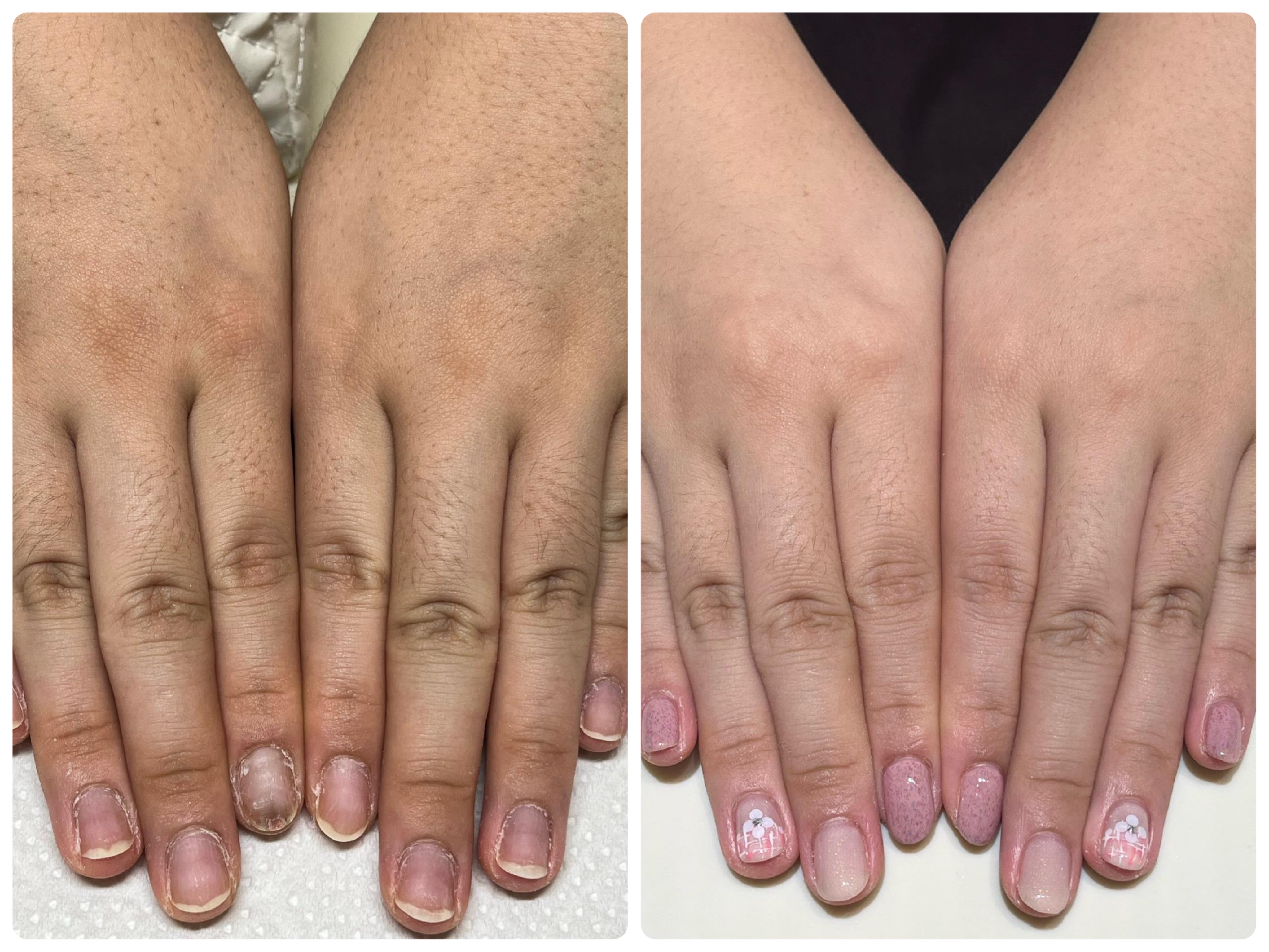 【お客様続出】“手が綺麗な人”がやっている指の関節の黒ずみケアとは