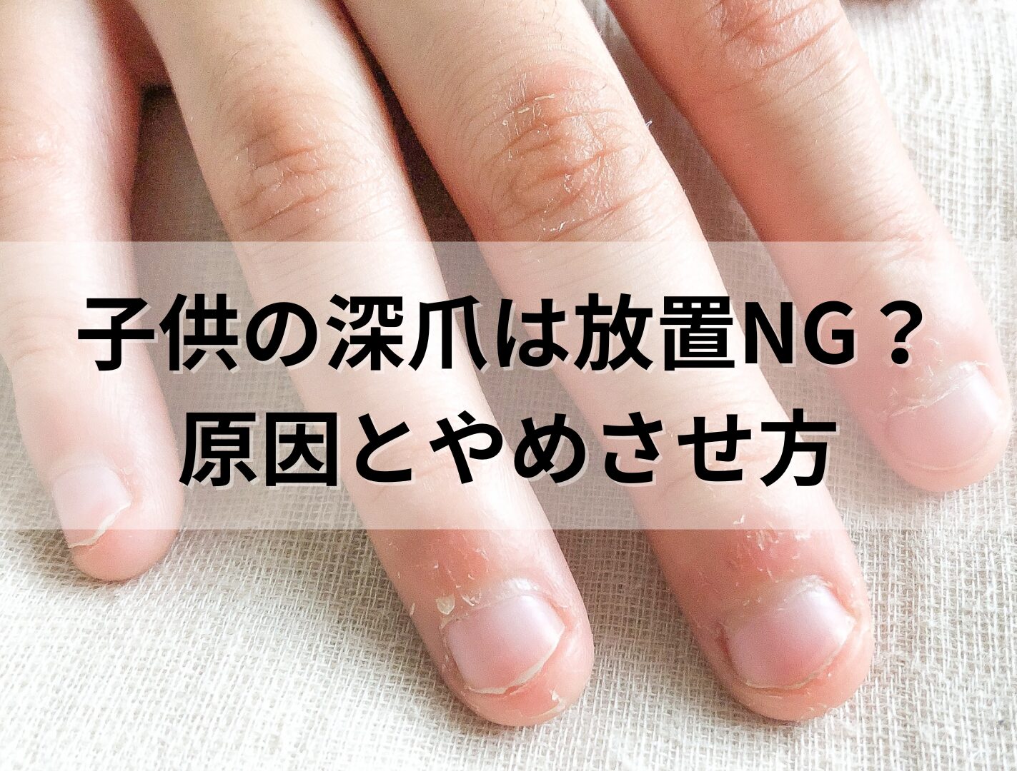 【東京】深爪は遺伝する？子供の爪噛み・噛み癖を放置するとどうなる？原因とやめさせる方法/子供の深爪矯正についても解説。
